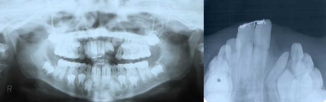 口唇口蓋裂の治療例（Ⅰ期治療）　左側口唇顎裂に起因する上顎前歯部叢生　骨移植前の動的治療中　パントモ＋上顎咬合法